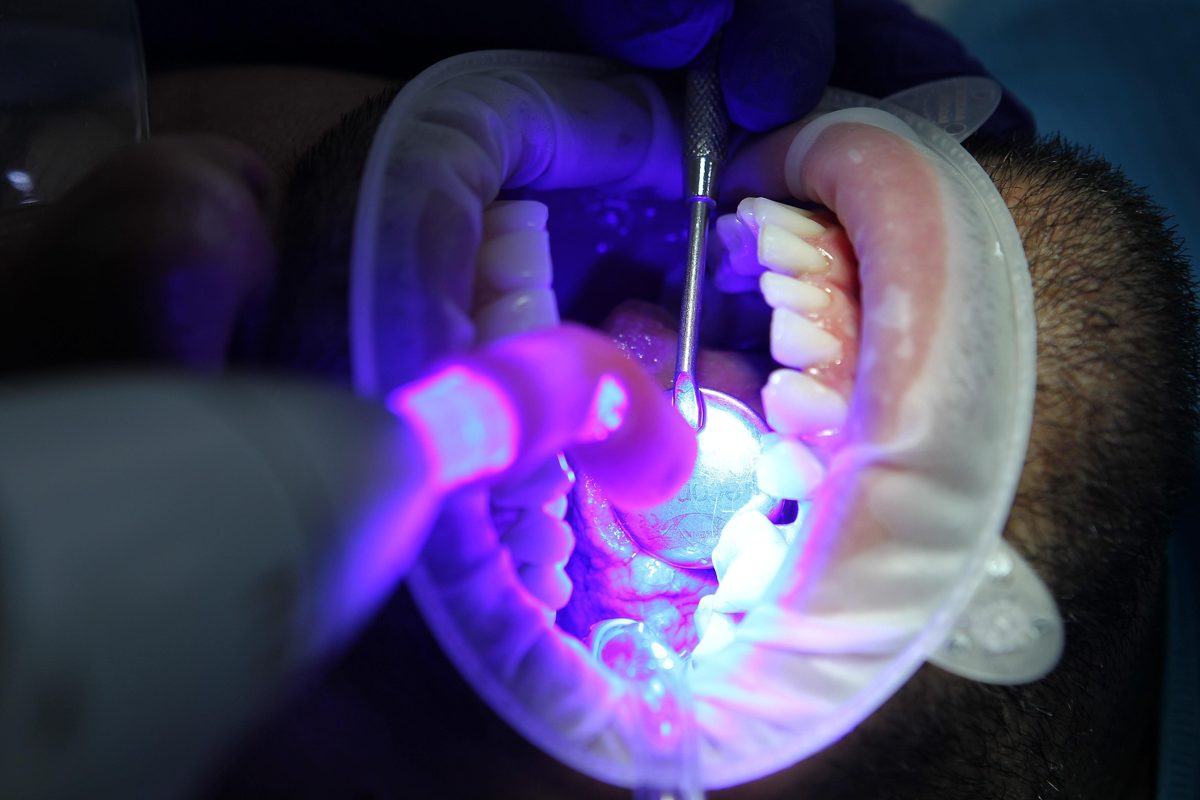 Sorriso branco após clareamento dental em São Bernardo do Campo