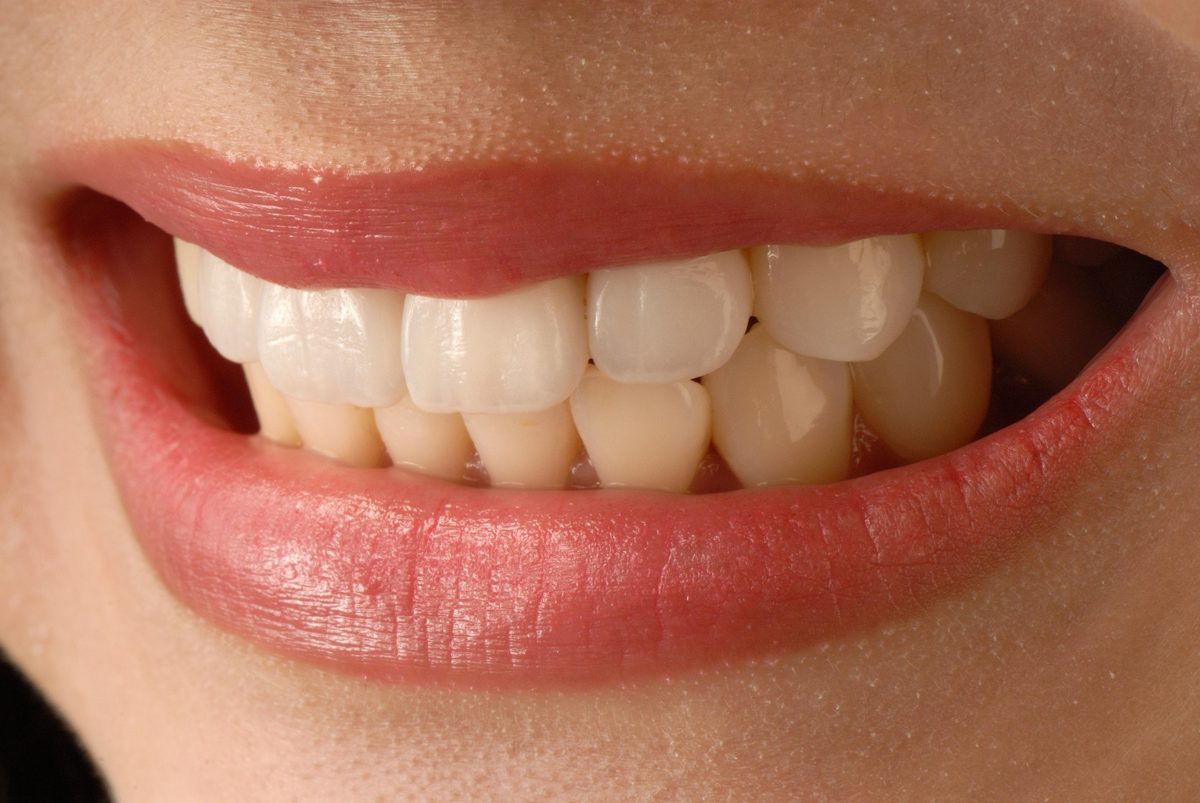 Facetas e lentes de contato dental em clínica de São Bernardo do Campo