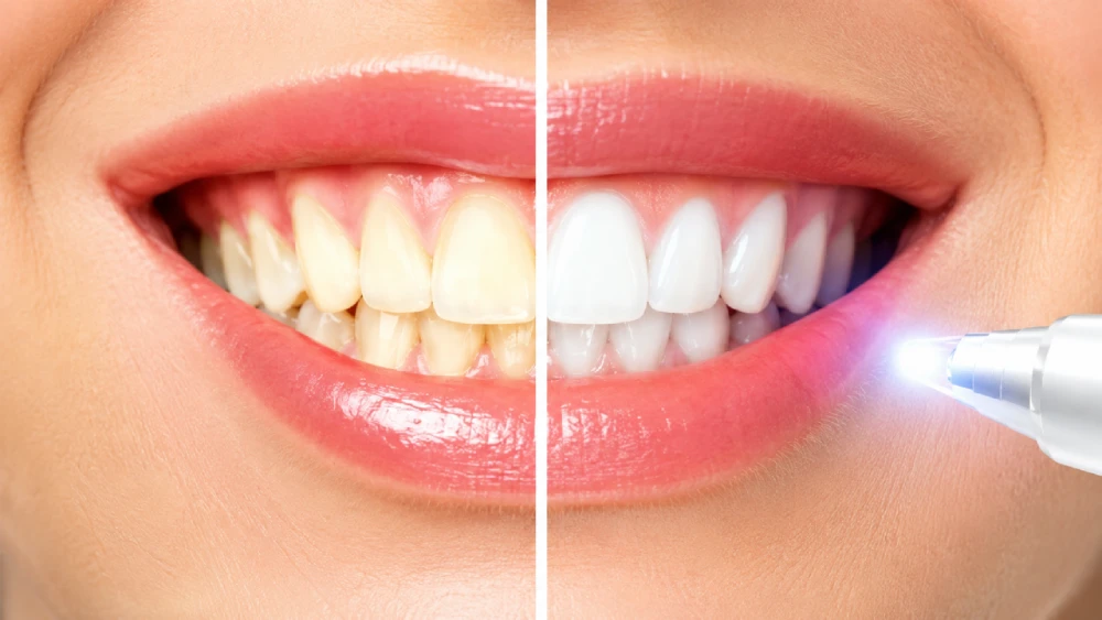 Clareamento Dental