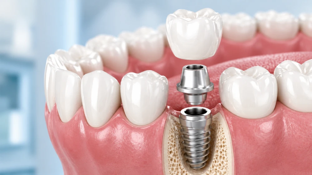 Implantes Dentários