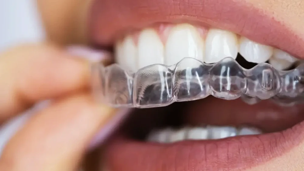 Invisalign